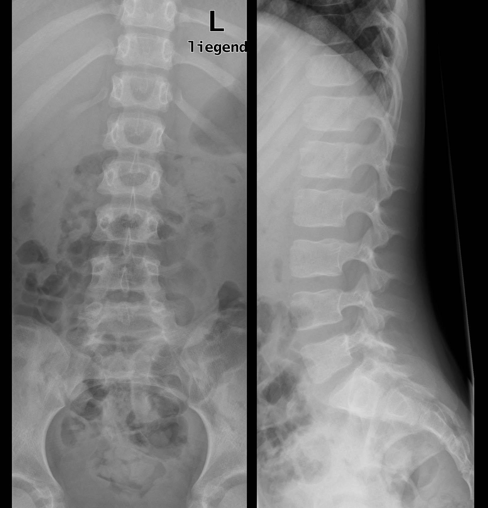 Bild 2/22 - Röntgenbild Radiograph : Stummelrippe Stub rib