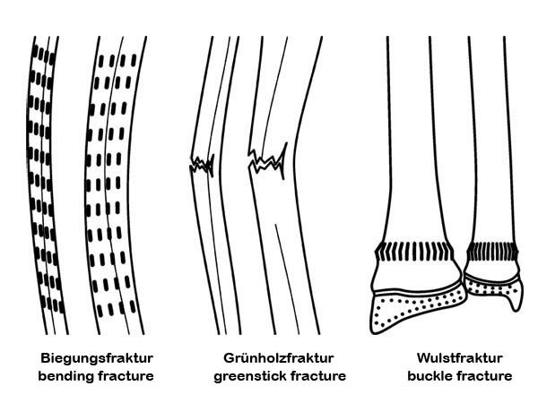 Grünholzfraktur Bis Zu Welchem Alter pedirad.elearning.aum.iml.unibe.ch
