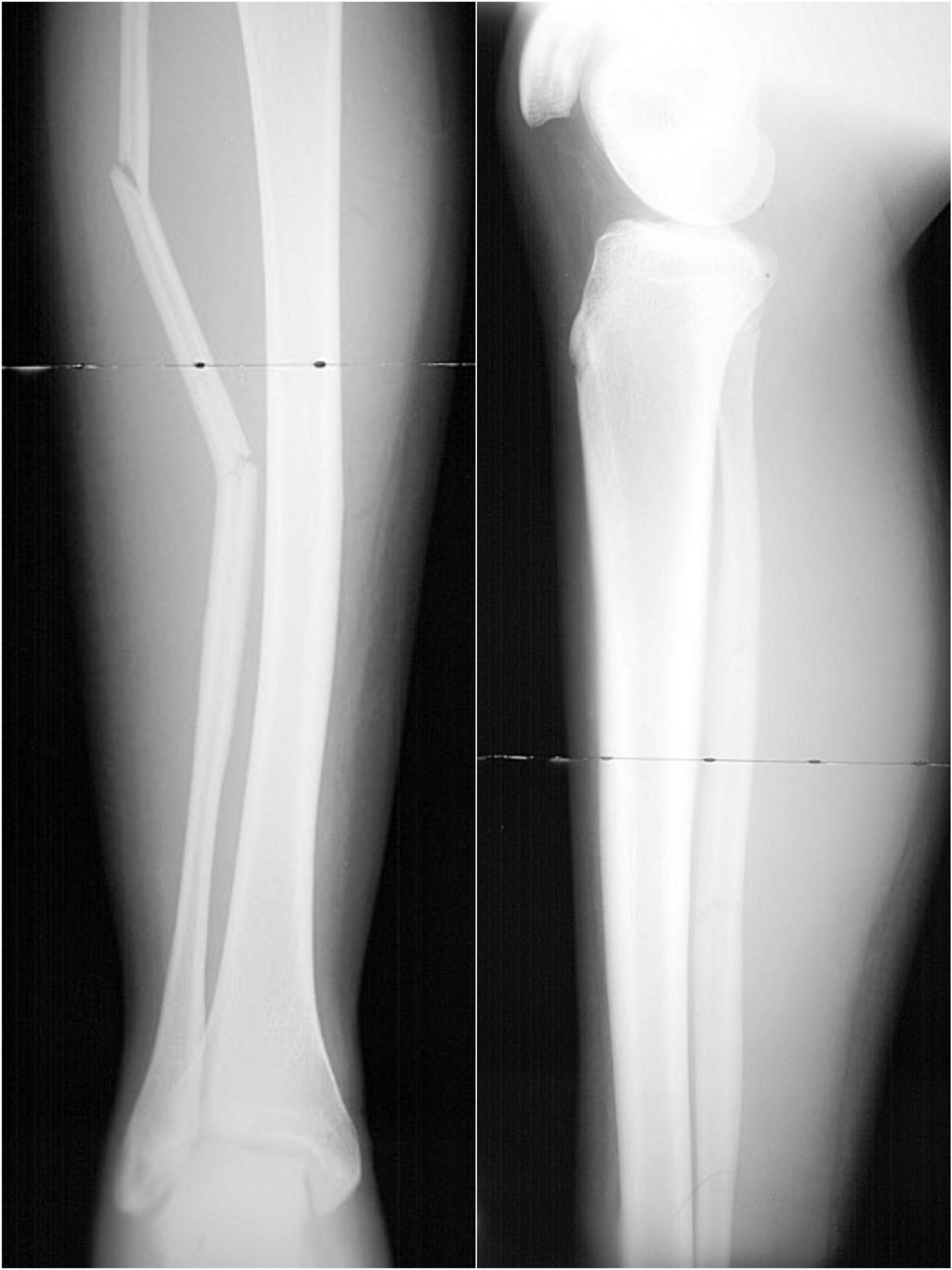 Bild 52/121 - Röntgenbild Radiograph : Fibulafraktur rechts