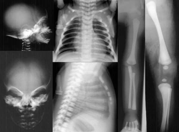 Bild 54/76 - Röntgenbild Radiograph : Osteopetrose