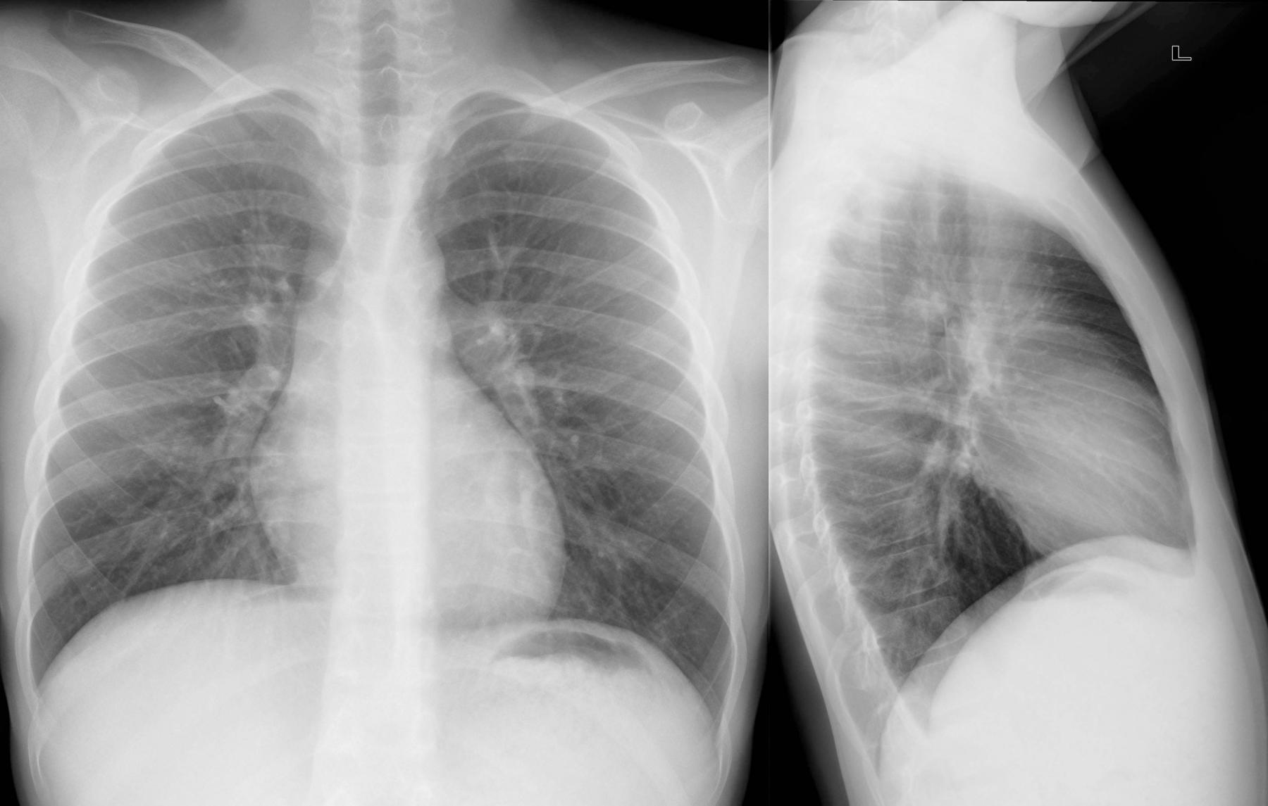 Bild 3/7 - Röntgenbild Radiograph : Normalbefund Normal findings