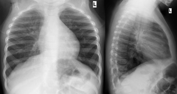 Kein Anhaltspunkt Für Pneumonie.