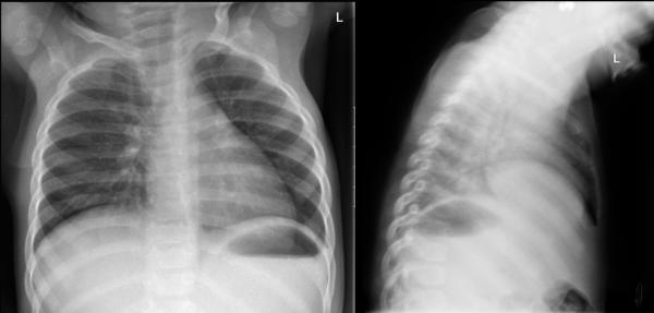 Kein Anhaltspunkt für Pneumonie.