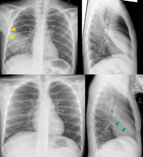 Kein Anhaltspunkt für Pneumonie.